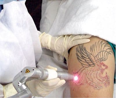 xóa hình xăm mày hư bằng công nghệ laser